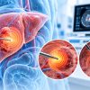 Tümör Ablasyonu Nedir? Mikrodalga ve RF Ablasyon Yöntemleri