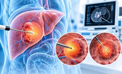 Tümör Ablasyonu Nedir? Mikrodalga ve RF Ablasyon Yöntemleri